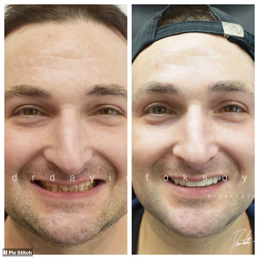 Before and after smile transformation showing improved tooth color and alignment