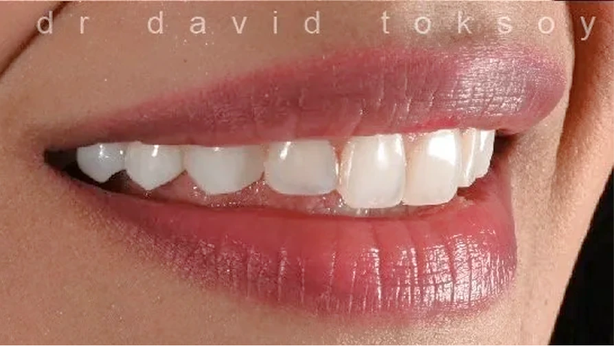 Close-up of patient's smile showing chipped front teeth before dental bonding treatment