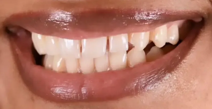 Close-up of aligned white teeth showing cosmetic dental results
