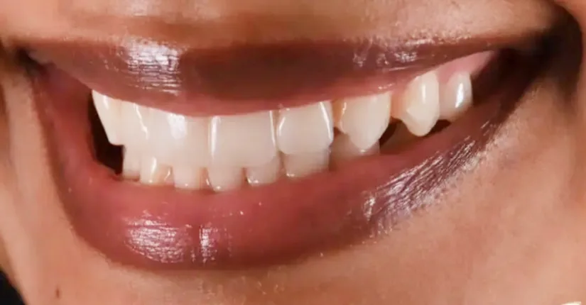 Close-up of bright white teeth showing cosmetic dental results