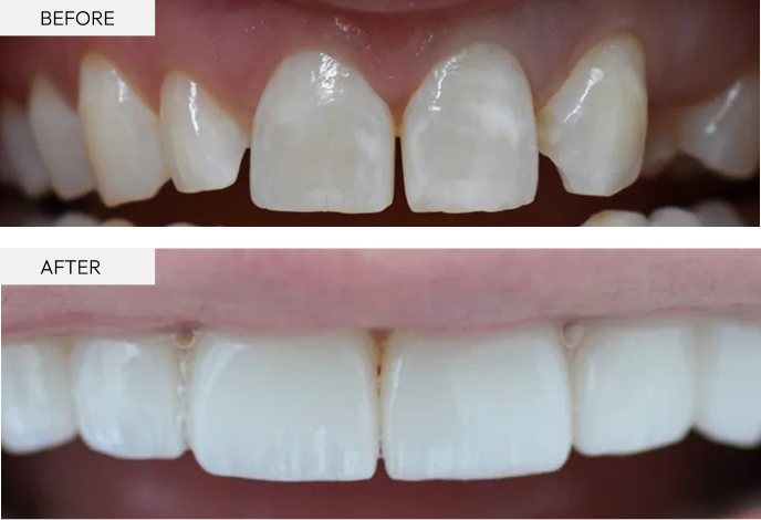 Before-and-after comparison: discolored, chipped front teeth before treatment; polished white teeth after cosmetic restoration