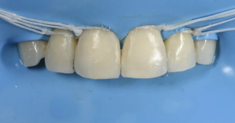 Black triangle between front teeth closed with Bioclear composite bonding, gumline contour rebuilt, Studio Dental NY
