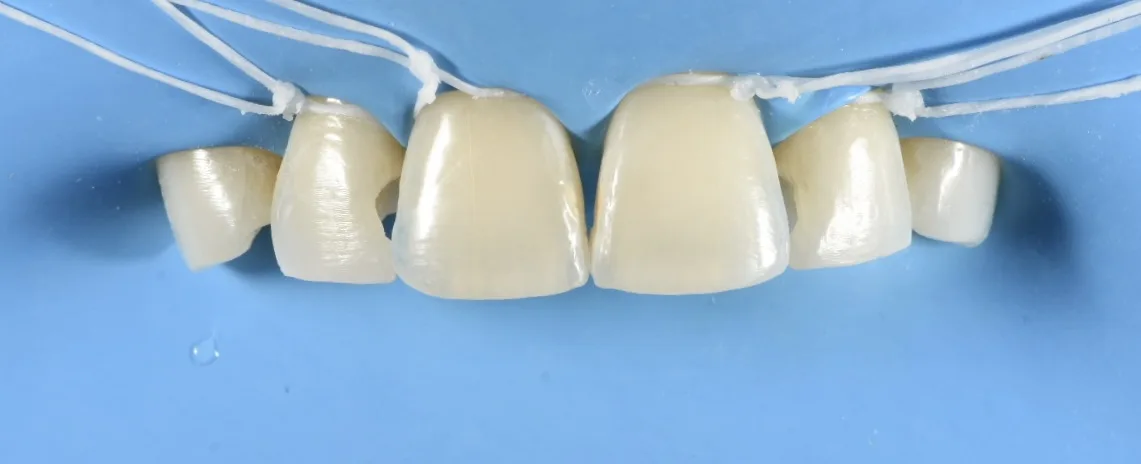 Wide view of the upper front teeth after Bioclear bonding closed a black triangle, still under rubber dam