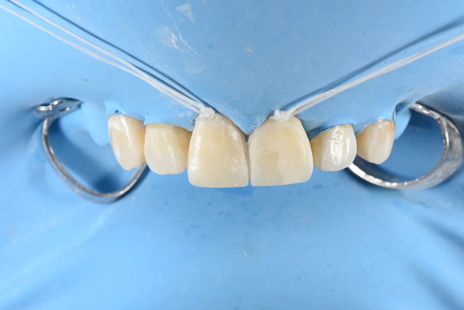 Composite bonding in place on both front teeth before rubber dam removal