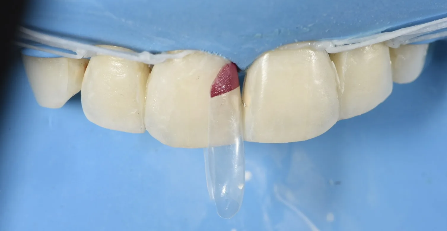 Bioclear clear matrix on upper front tooth under rubber dam to close a black triangle caused by gum recession, NYC