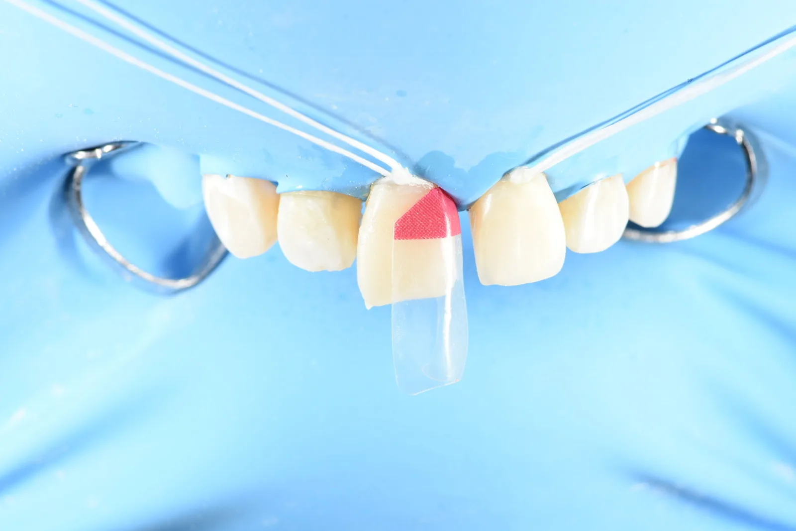 Bioclear clear matrix on front tooth under rubber dam during composite bonding
