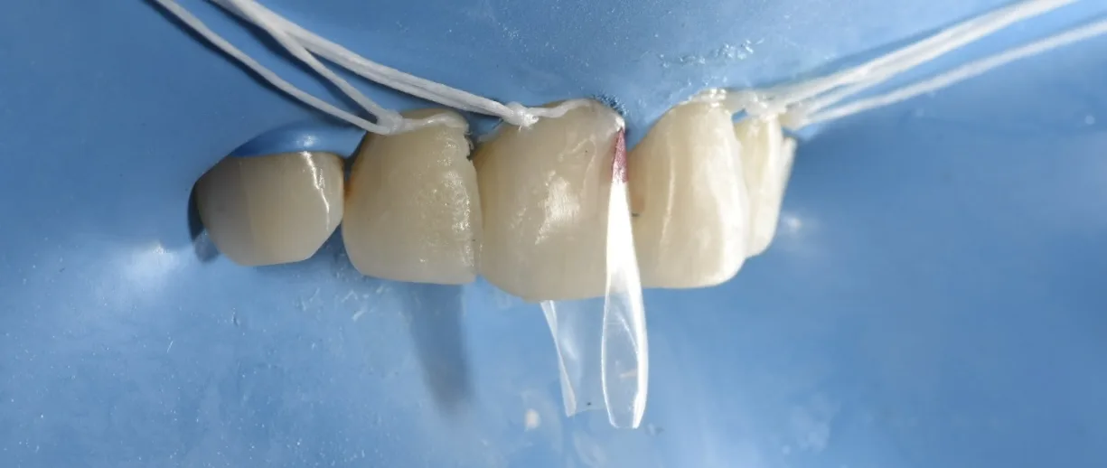 Wide view of Bioclear matrix placement under rubber dam before composite bonding