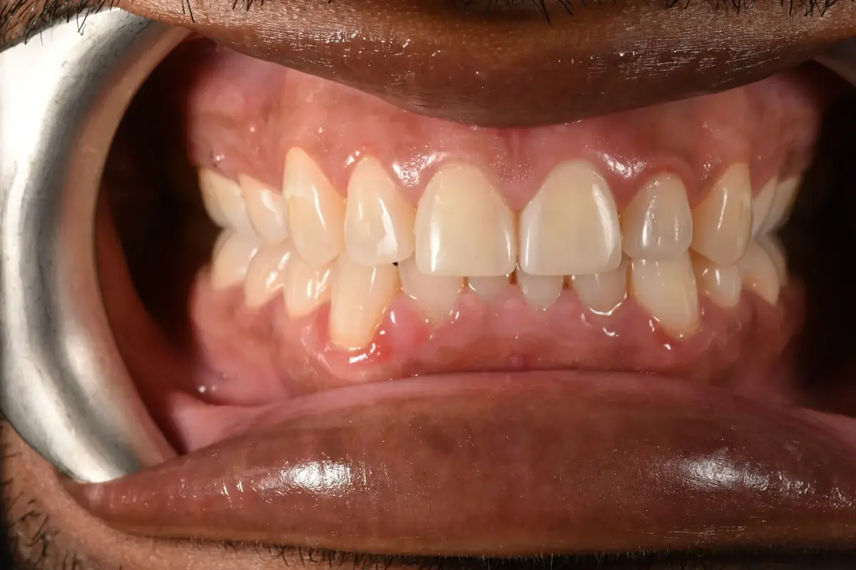 After Bioclear bonding, full smile view: front tooth gap closed and chipped edge rebuilt, Studio Dental NY