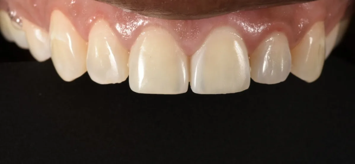 After Bioclear bonding: front tooth gap closed and chipped edge rebuilt, Studio Dental NY