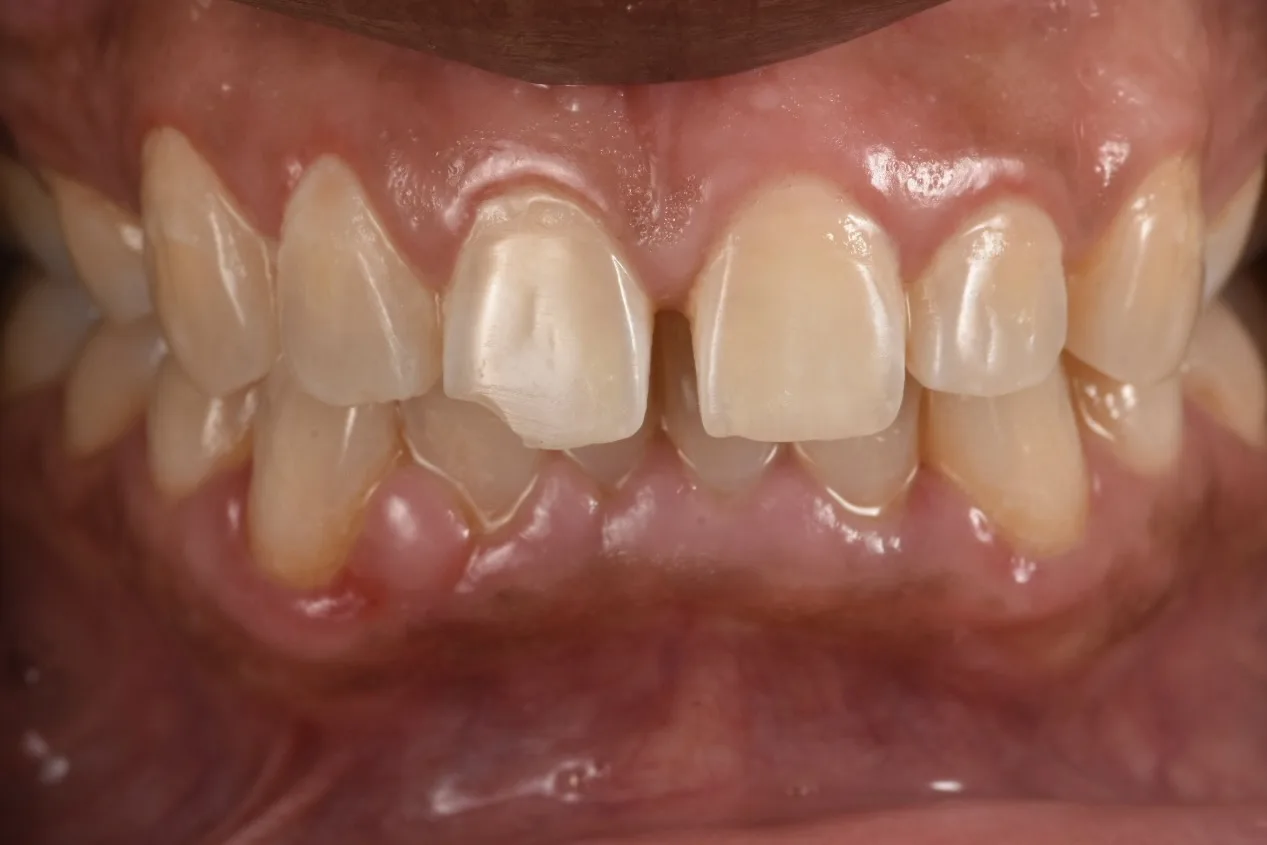 Before Bioclear bonding, full smile view: gap between upper front teeth and chipped incisal edge, NYC patient