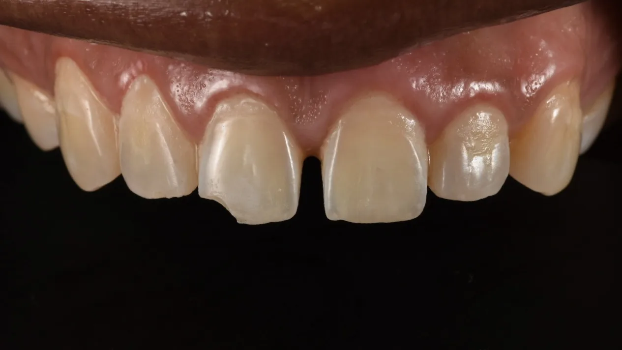 Before Bioclear bonding: gap between upper front teeth and chipped incisal edge, NYC patient