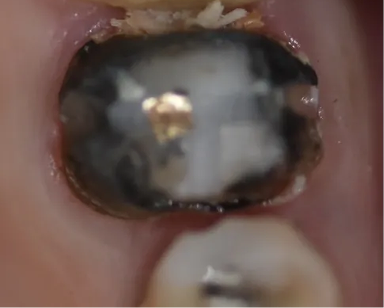 Intraoral view of tooth with dark restoration material during dental procedure