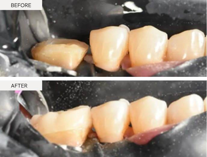 Before and after biomimetic dental restoration showing repaired tooth on left and completed natural-looking restoration on right