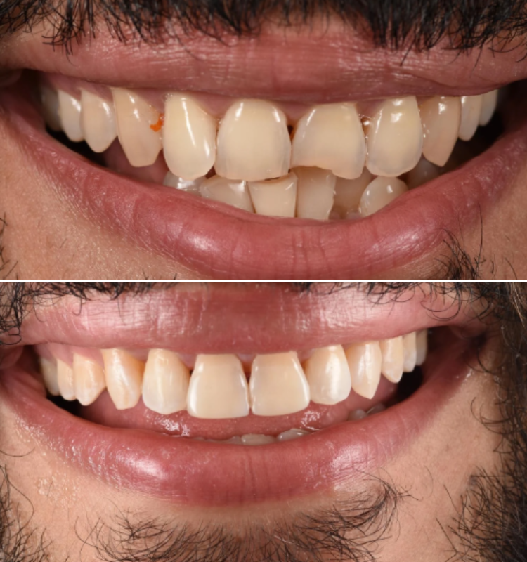 Before and after bonding showing two smiles with enhanced tooth appearance and symmetry