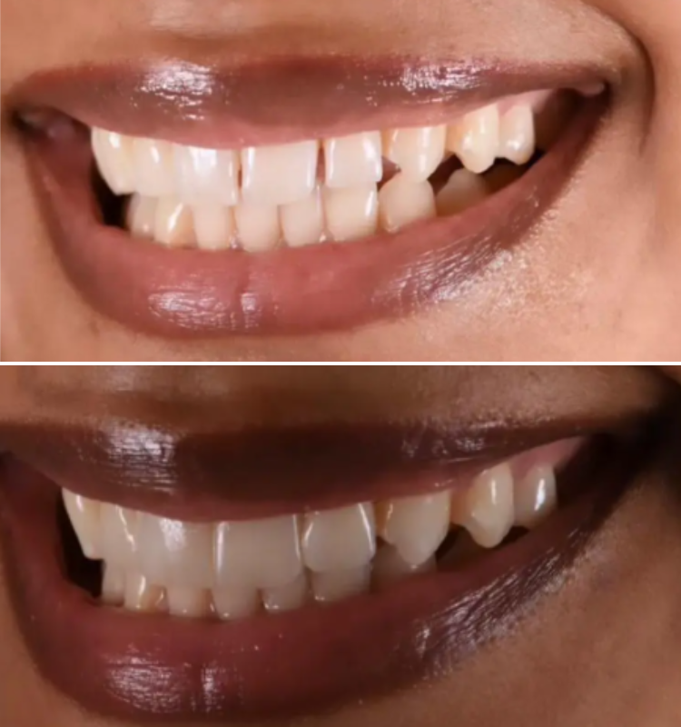Before and after bonding with two profile smiles showing improved tooth form and whiteness