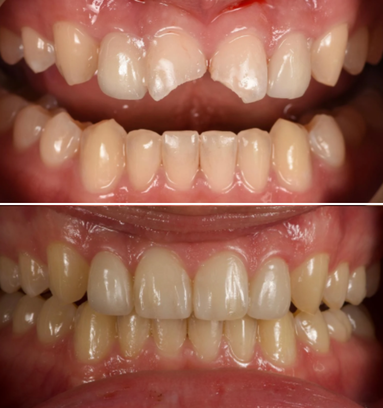 Before and after bonding treatment showing teeth restored to uniform shape and brightness
