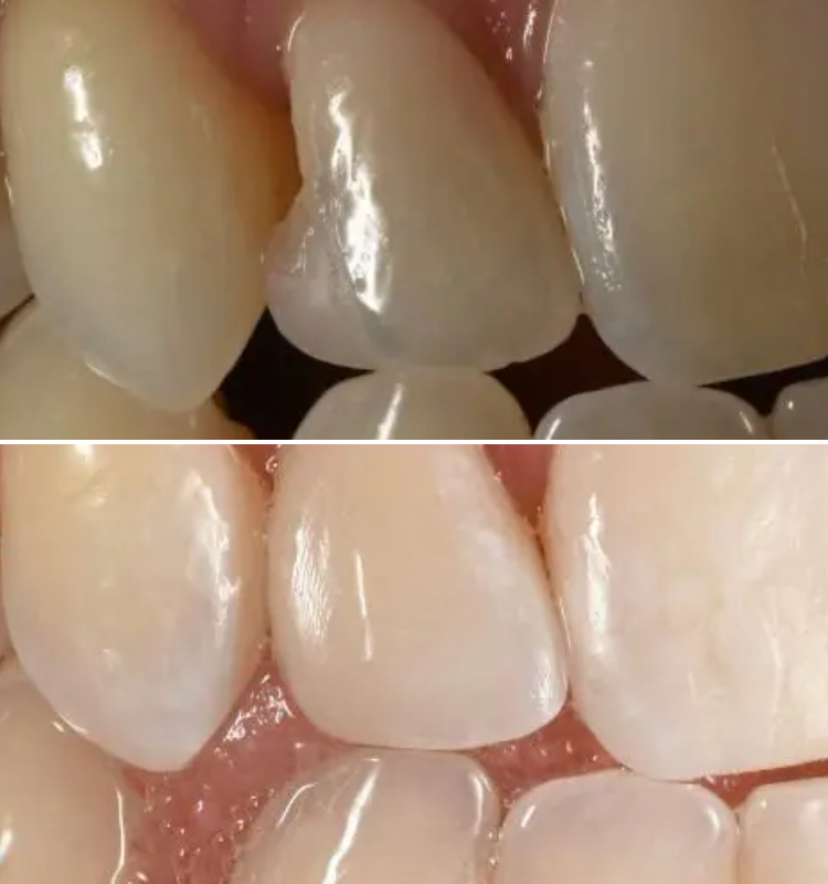Before and after bonding treatment showing three front teeth with improved shape and whiteness