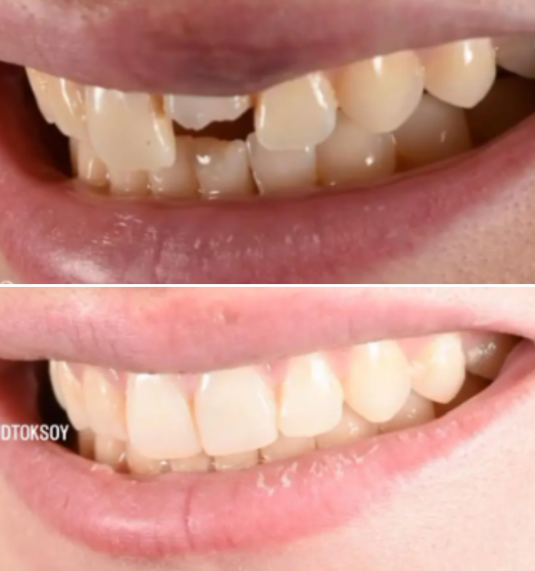 Before and after bonding showing upper front teeth with corrected shape and improved alignment