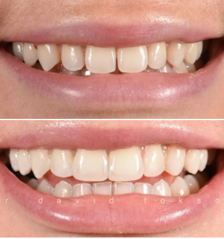 Before and after dental bonding results showing improved tooth appearance and smile