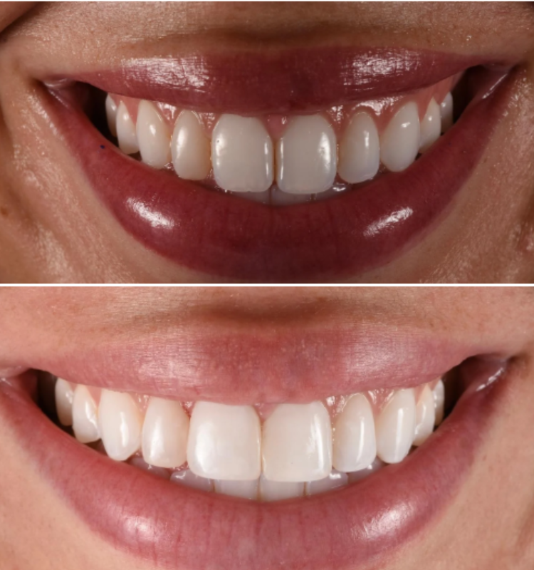 Before and after smile showing bonded front teeth appearing brighter and more uniform