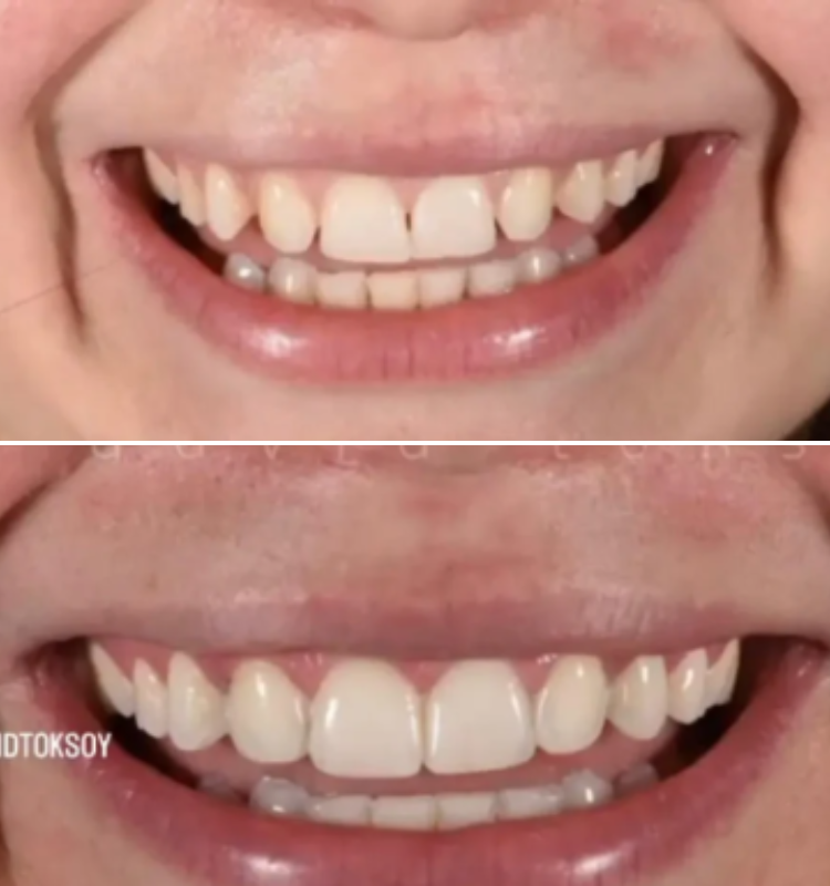 Before and after smile comparison of dental bonding results on front teeth