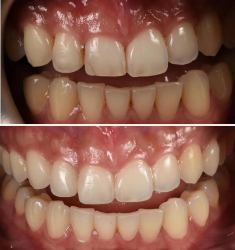 Before and after intraoral views of bonded upper and lower front teeth