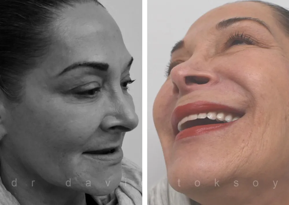 Before and after smile transformation showing improved tooth alignment and brightness