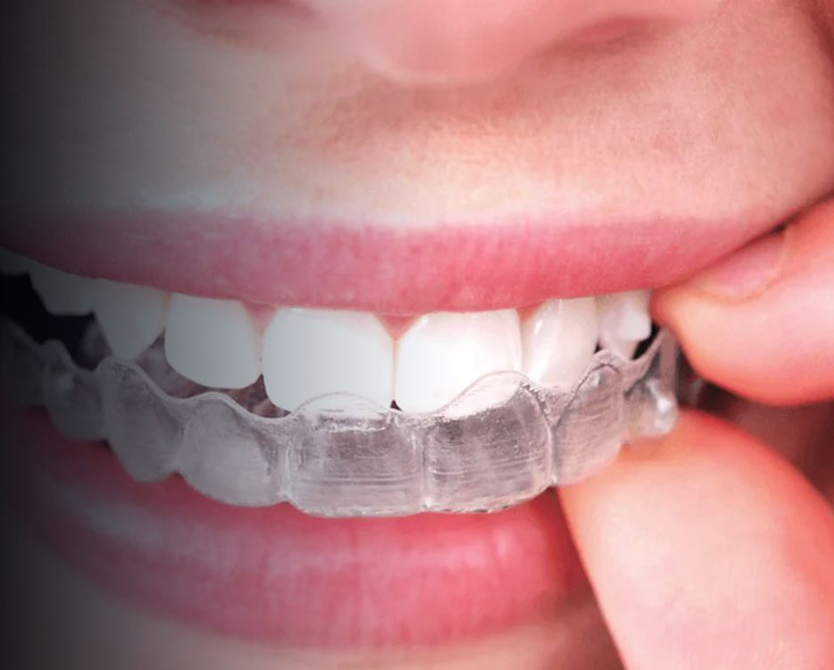 Clear aligner tray positioned over upper teeth showing orthodontic correction