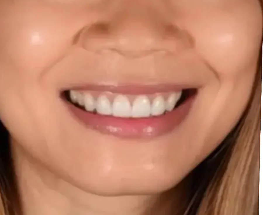Close-up of patient's bright white smile displaying improved tooth alignment and whiteness