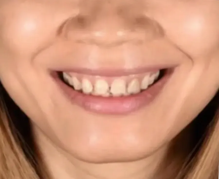 Close-up of patient's smile showing bright, even white teeth after cosmetic dental treatment