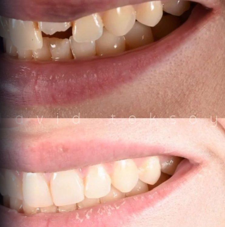 Close-up comparison of upper and lower teeth showing cracking and damage