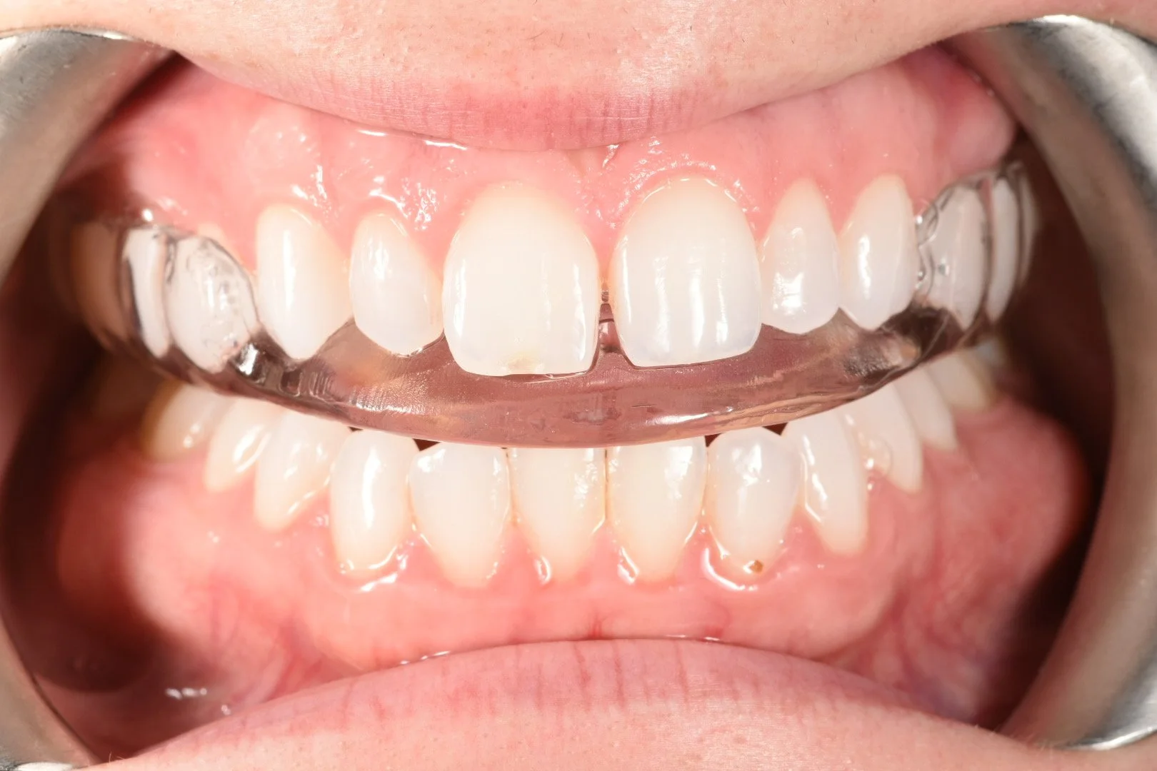 Front view of a clear custom nightguard seated on the upper teeth, biting together