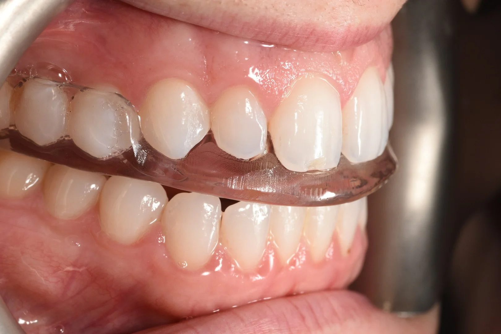 Side view of a clear custom nightguard fitted over a patient’s upper teeth for bruxism