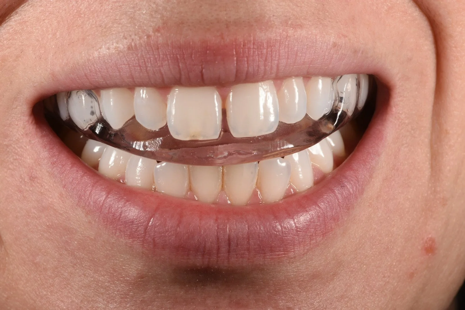 Patient smiling while wearing a thin, clear custom nightguard on the upper teeth