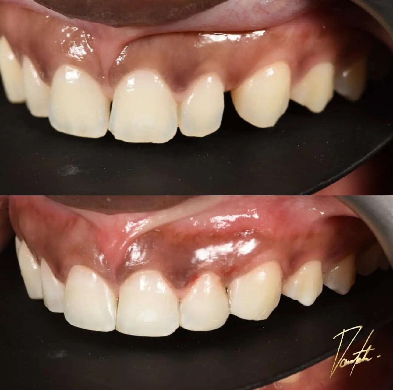 Before and after dental bonding on upper front teeth showing improved shape and gaps