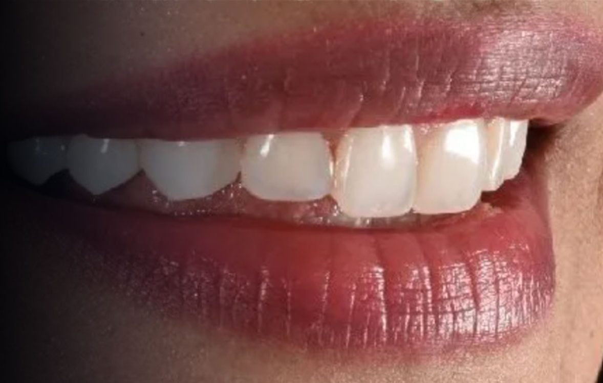 Close-up of upper teeth showing white dental bonding on front teeth