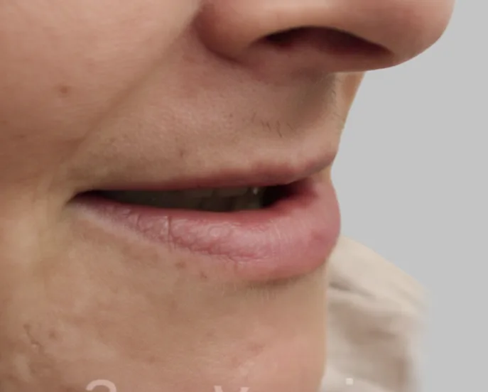 Side profile of person's mouth closed showing natural lip and facial contour