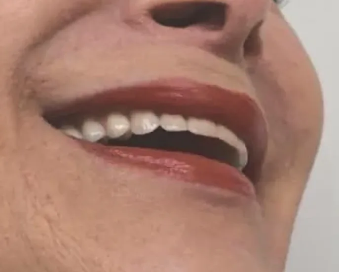 Side profile of person smiling showing aligned white front teeth