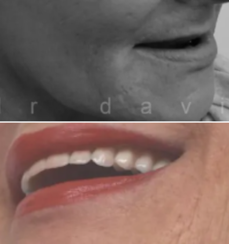 Dental implant case showing patient profile before treatment and smile with restored teeth after