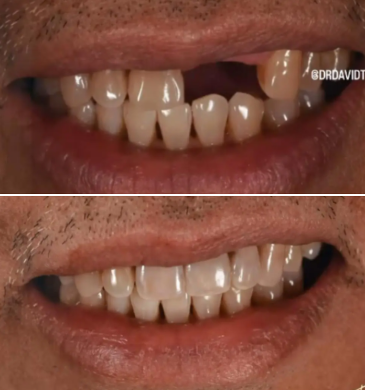 Before and after dental implant treatment showing upper teeth restored with natural-looking implant crowns
