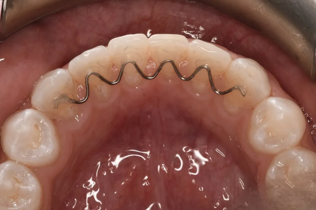 Upper dental arch with fixed orthodontic brackets and wires during Invisalign treatment in Manhattan