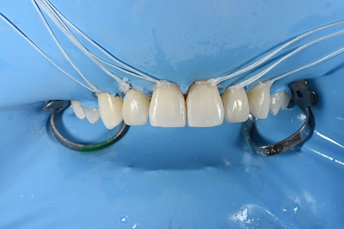 Dental bonding shade guide showing tooth-colored resin samples arranged on a blue model with varying opacity levels