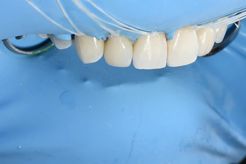 Dental bonding shade guide showing tooth-colored composite resin samples against a blue background
