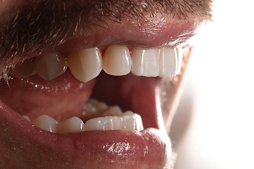 Close-up of a patient's smile showing bonded teeth with natural-looking restoration