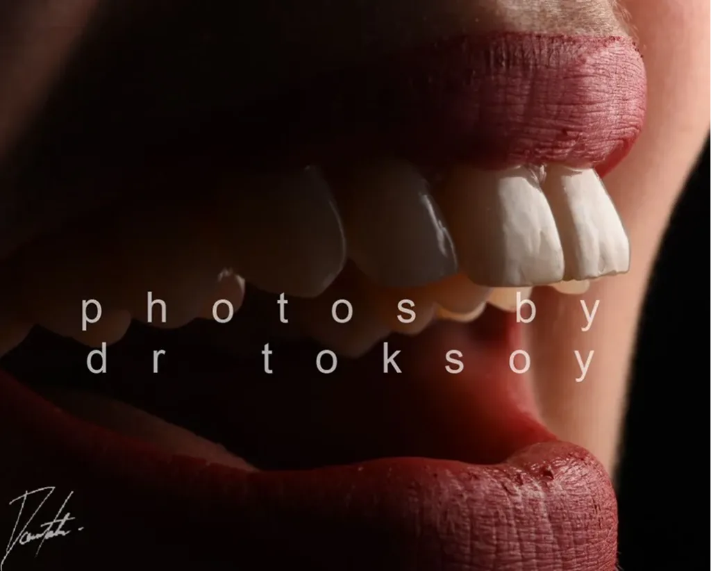 Close-up of person's smile showing four white porcelain veneers on upper front teeth