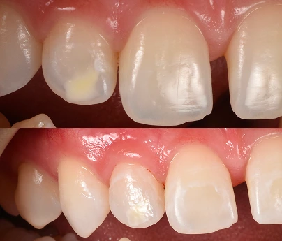 Before and after white spot treatment on upper front teeth, showing improved enamel appearance