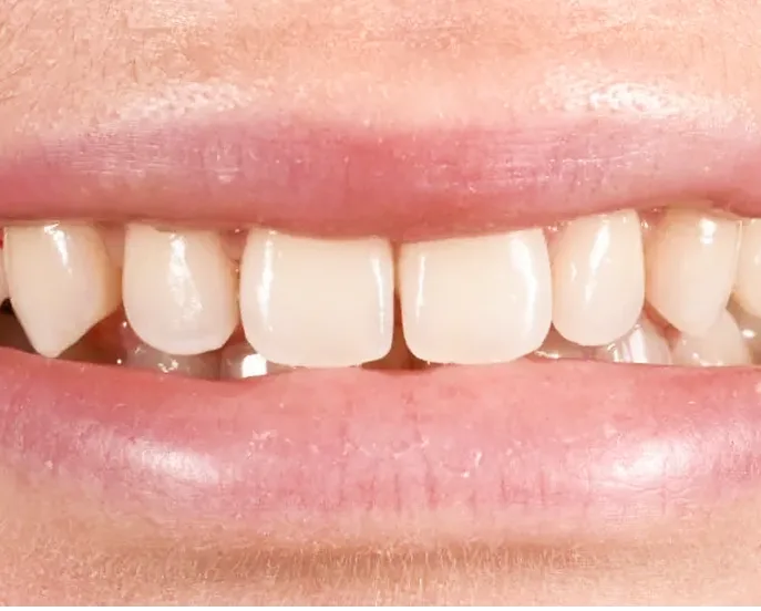 Close-up of upper front teeth with natural white shade and healthy pink gums