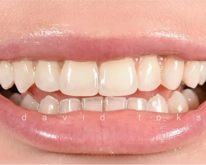 Front smile showing upper and lower teeth with david toks branding watermark