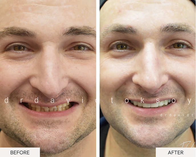 Before and after male patient smile comparison showing improved tooth color and alignment
