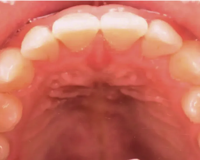 Overhead view of upper dental arch showing front teeth with white coloring